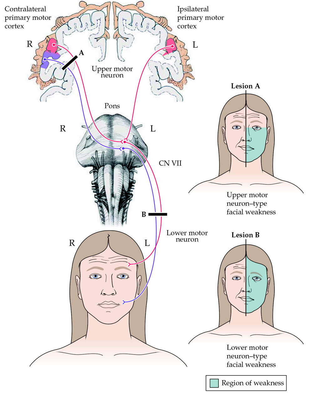 Bells Palsy